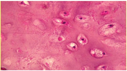 The Naso-Sinusian Chondrosarcoma: Case Report and Review of Literature