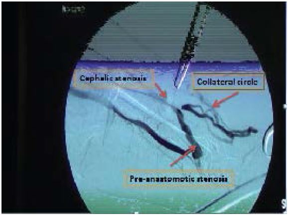 Percutaneous Endovascular Treatment of one Pseudoaneurysm of an AVF ...