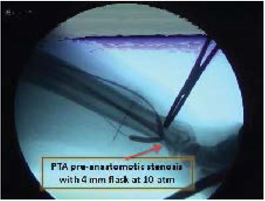 Percutaneous Endovascular Treatment of one Pseudoaneurysm of an AVF ...