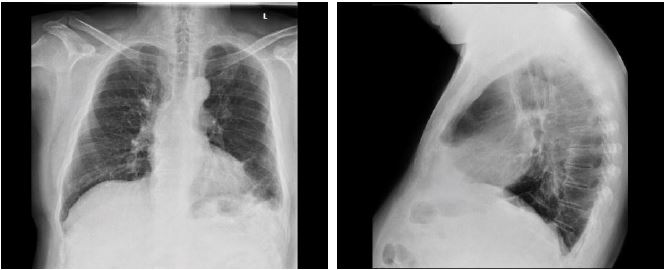 Laparoscopic Diaphragmatic Hernia Repair in a Patient with Bullous ...